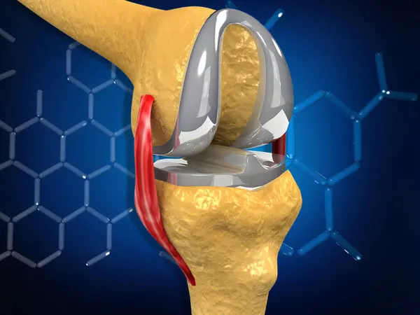 Knee Replacement Concept Illustration — Stock Photo, Image