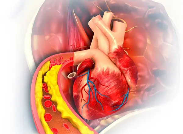 Human heart with clogged artery. 3d illustration
