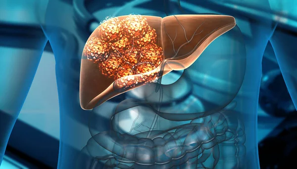 Crecimiento Células Cancerosas Del Hígado Humano Ilustración —  Fotos de Stock