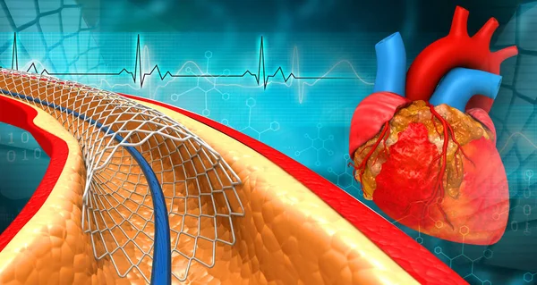 Human Heart Balloon Angioplasty Illustration — Stock Photo, Image