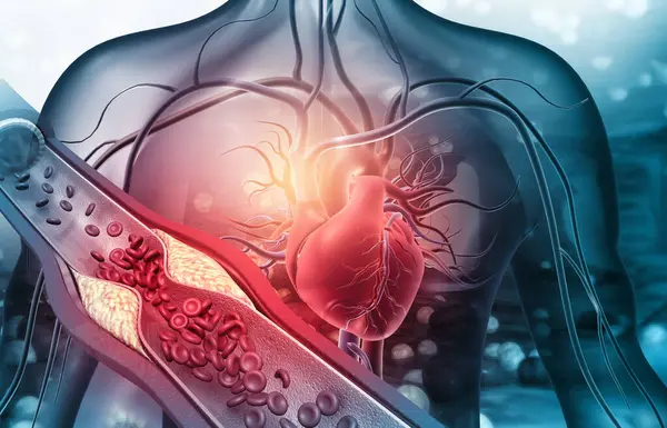 Menschliches Herz Mit Verstopften Arterien Illustration — Stockfoto