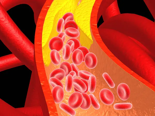 Clogged Arteries Scientific Background Illustration — Stock Photo, Image