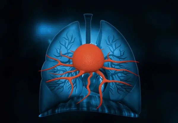 Human Lungs Cancer Cell Illustration — Stockfoto