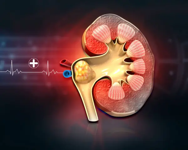 Deceased kidney on medical background. kidney kidney stones. 3d illustration