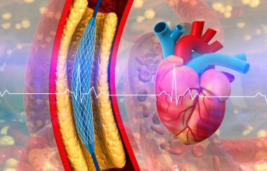 Karotid arter anjiyoplasti ve kalp. 3d illüstrasyon