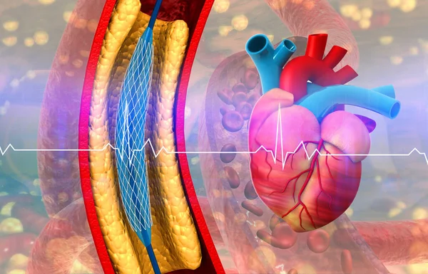 Carotid Artery Angioplasty Heart Illustration — Stock Photo, Image