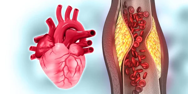 Cholesterol Blocked Arteries Human Heart Illustration — Stock Photo, Image