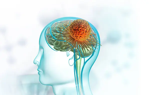 Brain Tumor Medical Concept Illustration — Stock Photo, Image