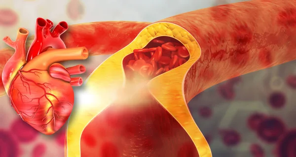 Colesterol Bloqueado Artérias Com Coração Humano Ilustração — Fotografia de Stock