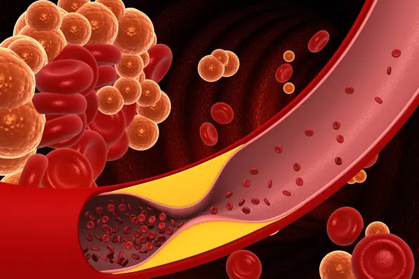 Cholesterol Blocked Arteries Illustration — Stock Photo, Image
