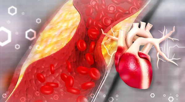 Clogged Arteries Human Heart Heart Attack Illustration — Stock Photo, Image