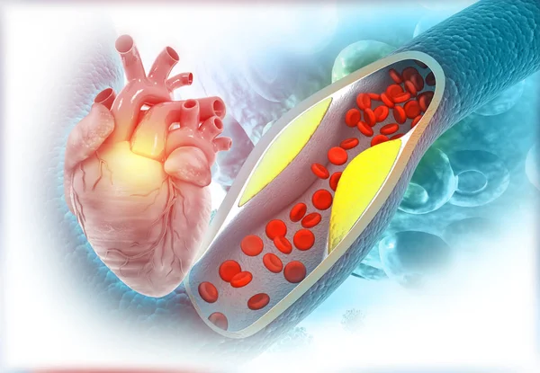 Clogged Arteries Human Heart Heart Attack Illustration — Stock Photo, Image