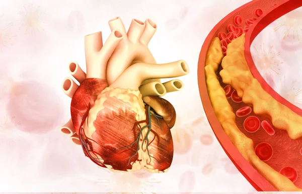 Human Heart Clogged Artery Illustration — Stock Photo, Image