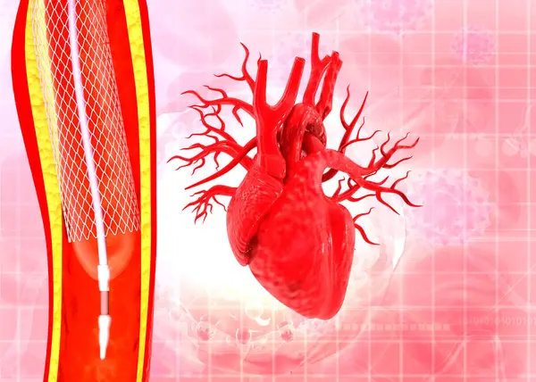 Menschliches Herz Mit Angioplastik Illustration — Stockfoto