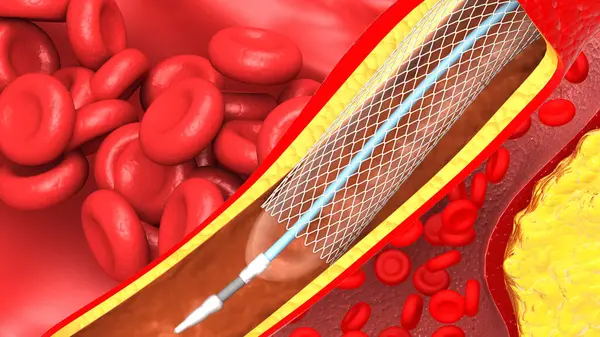 Clogged Arteries Medical Concept Illustration — Stock Photo, Image