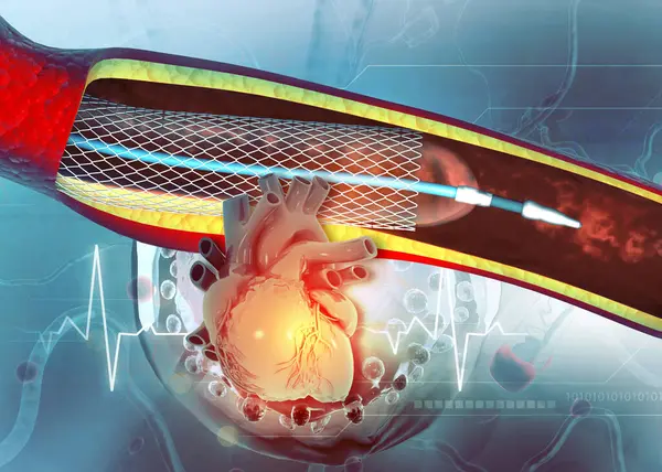 Lidské Srdce Angioplastikou Ilustrace — Stock fotografie