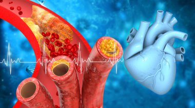 Tıkanmış arterler, insan kalbi olan koroner arter plağı. 3d illüstrasyon