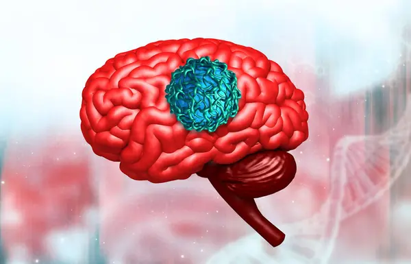 Концепция Опухоли Мозга Иллюстрация — стоковое фото