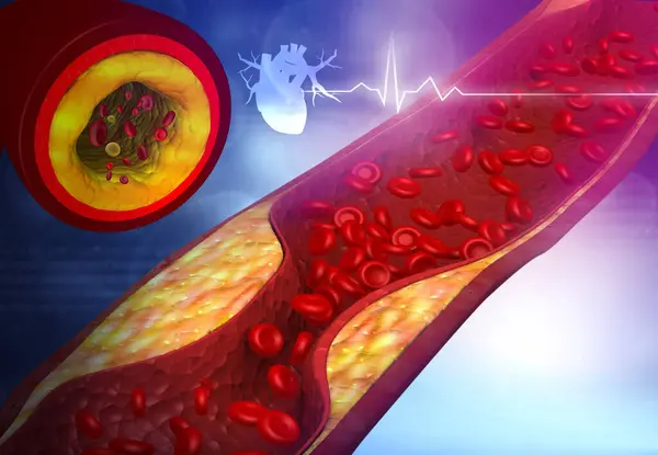 Tepna Ucpaná Špatným Cholesterolem Ucpané Tepny Plak Věnčité Tepny Ilustrace — Stock fotografie