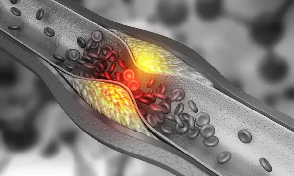 Artery Blocked Bad Cholesterol Clogged Arteries Coronary Artery Plaque Illustration — Stock Photo, Image
