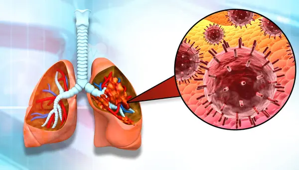 人类肺部的病毒感染 3D说明 — 图库照片