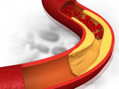 Atardamar kötü kolesterolle tıkanmış. Tıkanmış arterler, koroner arter plağı. 3d illüstrasyon
