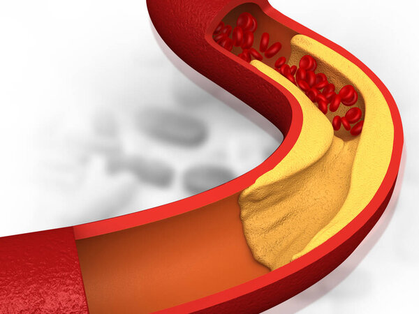 Artery blocked with bad cholesterol. clogged arteries, coronary artery plaque. 3d illustration	