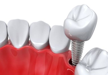 Diş implantı konsepti. 3d illüstrasyon
