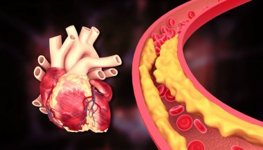 Atardamarda kolesterol plağı ve insan kalbi anatomisi. 3d illüstrasyon