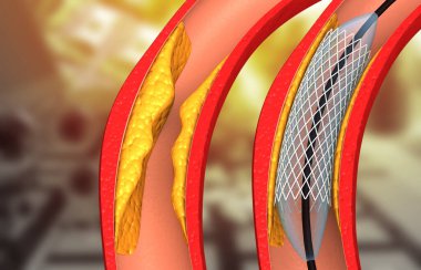 Tıkanmış kan damarları için stent yerleştirme. 3d illüstrasyon