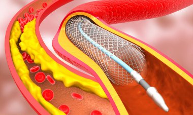 Tıkanmış kan damarları için stent yerleştirme. 3d illüstrasyon