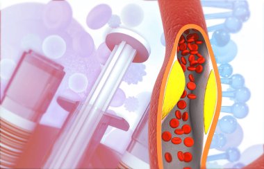 İnsan damarlarında kolesterol. 3d illüstrasyon