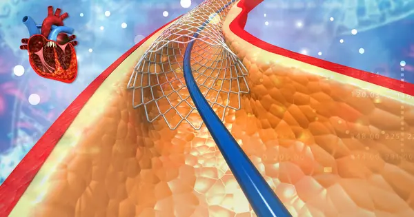 Stock image Angioplasty stent in heart. 3d illustration	