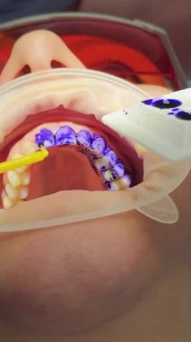En son diş temizleme teknolojisi, hemşire ve doktor hastaların dişlerini tedavi ediyor. Üst dişleri temizliyorum. Doktorların yüzlerinde koruyucu maskeler, eldivenler, temizlik ve temizlik. 4k görüntü