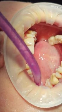 The use of vacuum cleaners and saliva pumps at the dentists office. The dentist and his assistants provide assistance to the patient. Helping the patient with caries and brushing teeth. High quality
