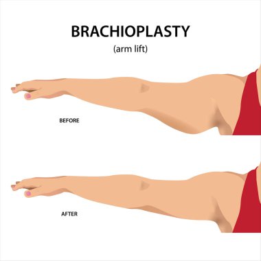 Tedaviden önce ve sonra Brachioplasty (kol kaldırma) çizimi