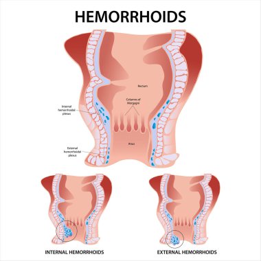 Hemoroit İç ve Dış Hemoroit İllüstrasyonu