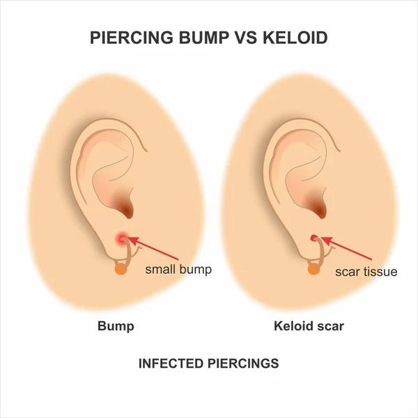Piercing bump vs Keloid illustration Ear piercing infection