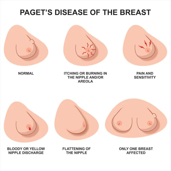 Breast cancer sign and symptoms illustration