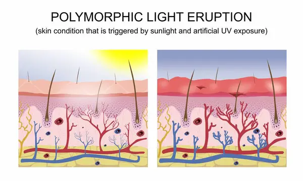 Polymorphic Light Eruption Illustration — Stock Photo, Image