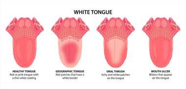 Beyaz Dil illüstrasyonu, Ağız Ardıcı, Ağız Ülseri ve Coğrafi Dil