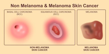 Non Melanoma & Melanoma Cilt Kanseri İllüstrasyonu