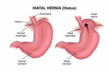 Hiatal fıtık (ara) 3D illüstrasyon