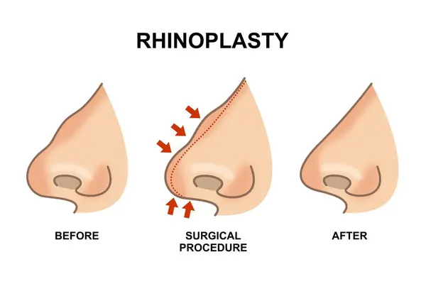 Rinoplastia Cirugía Nariz Antes Después Del Procedimiento — Archivo Imágenes Vectoriales