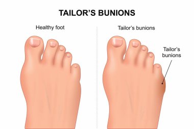 Terzi Ayak Parmağı Gösterimi