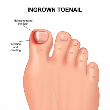 Büyümüş ayak tırnağı ayak ağrısı ve iltihaplanma ile insan ayağı, tıbbi ve sağlık hizmetleri