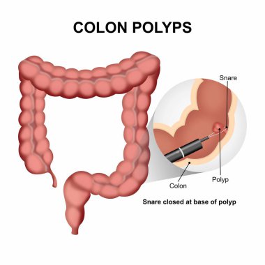 Colon Polyps removal surgery illustration clipart