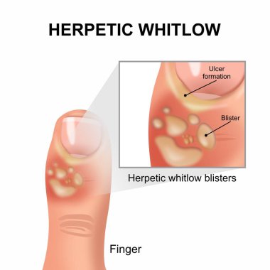 Herpetic whitlow infection in finger illustration clipart