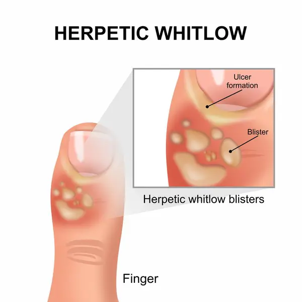 stock vector Herpetic whitlow infection in finger illustration