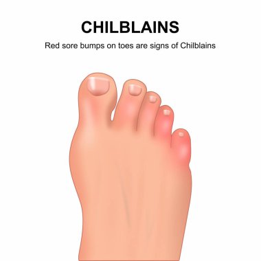 Chilblains kırmızılığı şişkinlik işareti çizimi